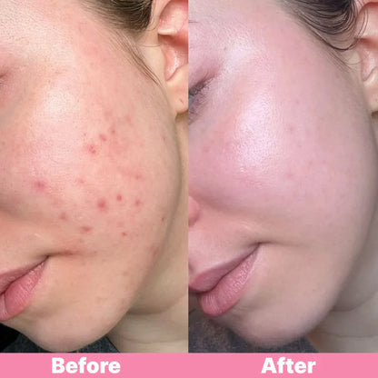 Hydrocolloid Skincare Tape (Pimple Patch Roll)