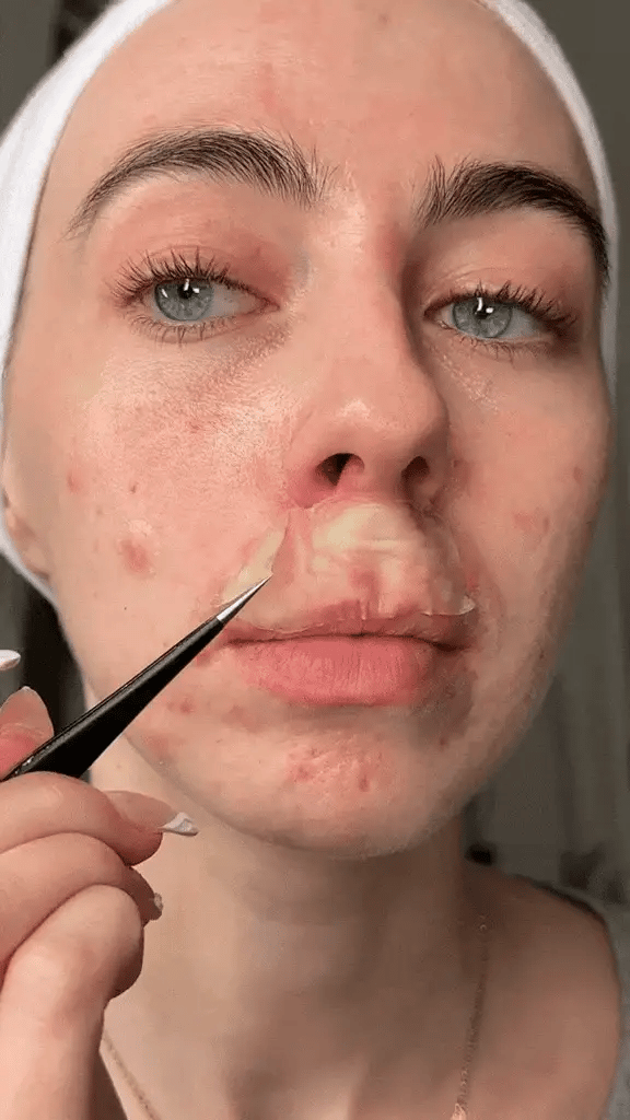 Doctor-Trusted Hydrocolloid Roll – For Fast Healing & Pimple Care